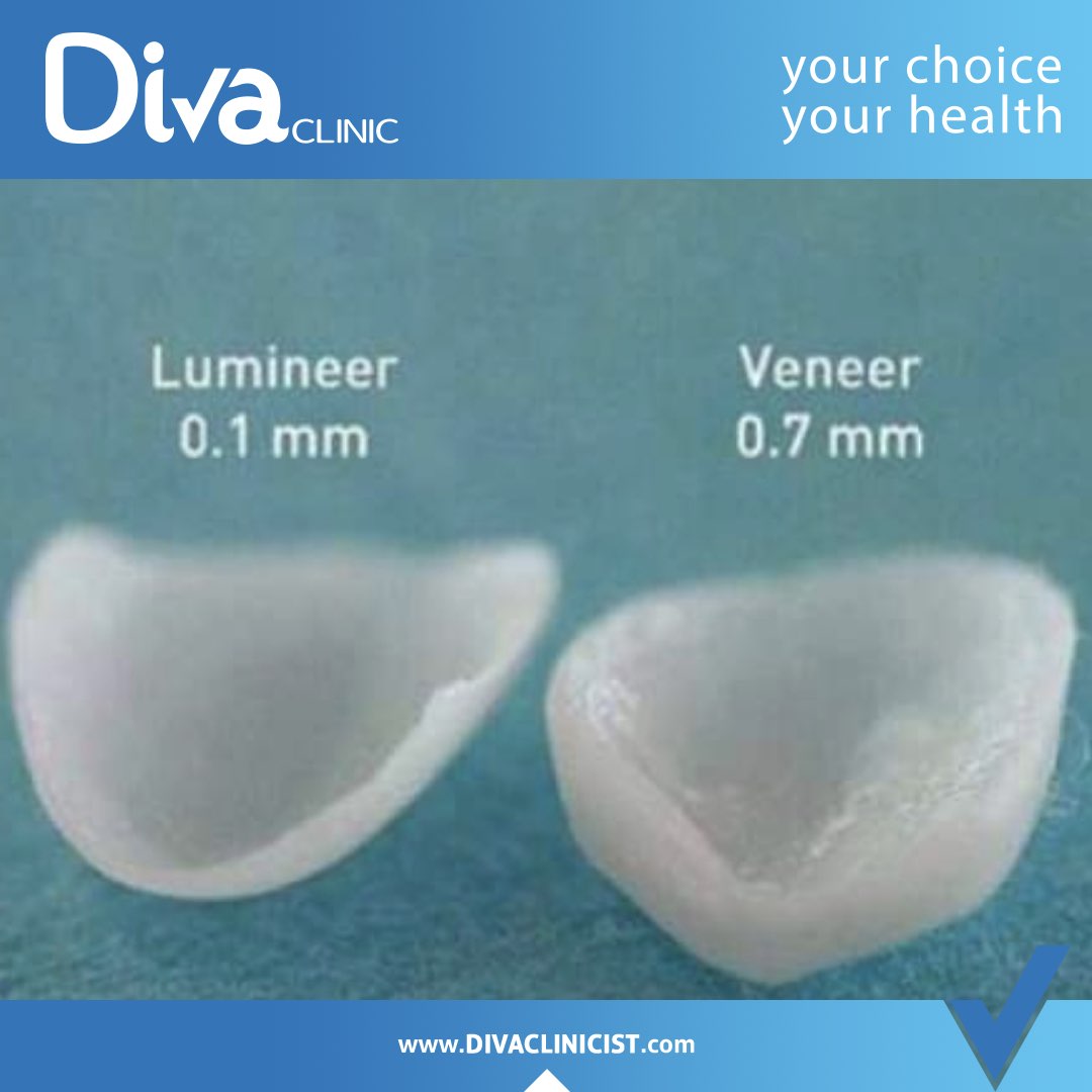 The difference between veneers and lumineers
