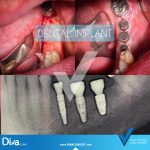 نتائج زراعة الأسنان في ديفا كلينيك