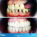 نتائج زراعة الأسنان في ديفا كلينيك